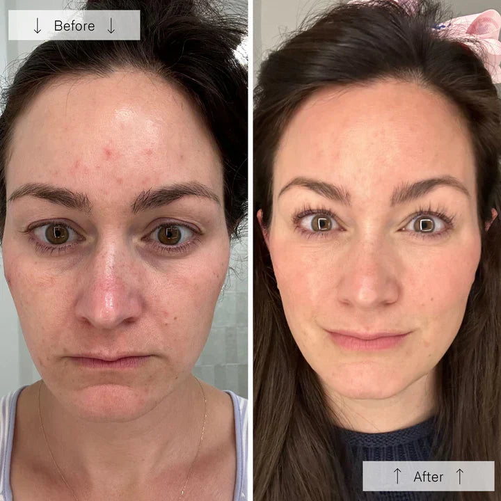 EMS Microcurrent Device Benefits for Younger Looking Skin