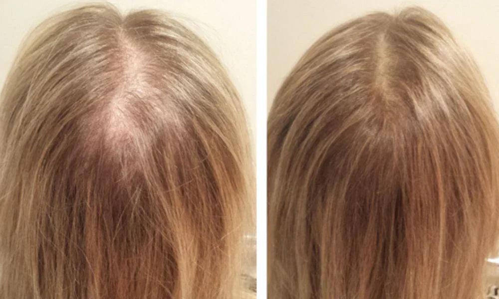 Red Light Therapy for Hair Growth: Does It Really Work?